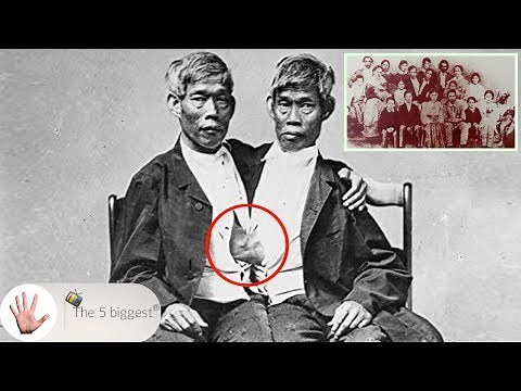 Conjoined Twins Got Married and Had 21 Children! Full Story of The Siamese Twins! ~ Body Bizarre!