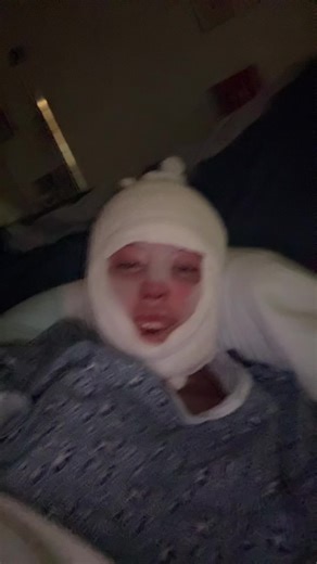 Empowering Journey of a Burn Survivor
