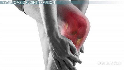 Joint Effusion: Definition, Causes, Symptoms & Treatment