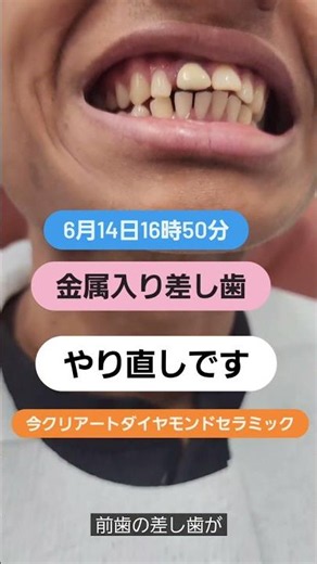 過去に入れた金属入り差し歯のキワの黒ずみ、歯のお痛みがある方です。キワの黒ずみも仮歯で改善できます#セラミック #ダイヤモンド今井 #毎日前歯の今井です
