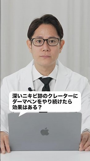 Effect of Dermapen on acne scars #shorts