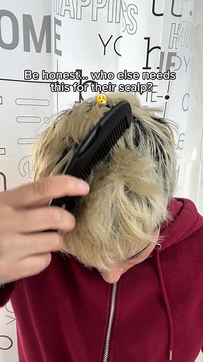 Effective Tips to Remove Dandruff for Healthy Scalp