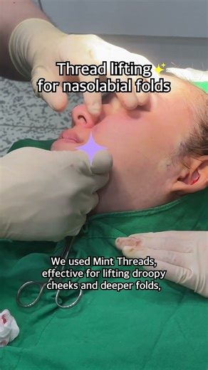 Thread lifting for nasolabial folds❤️