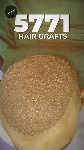 High Density Hair Transplant | Norwood Grade 6