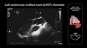 Learn how to assess the aortic valve (mid-esophageal long-axis view)...