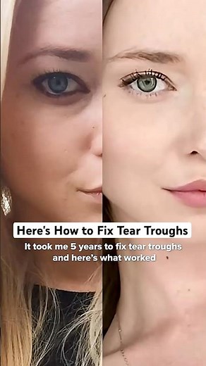 Here's How to Fix Tear Troughs
