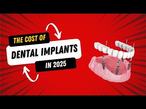 The REAL Cost of Dental Implants in 2025 (What Dentists Don't Tell You)