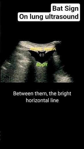 Bat Sign On lung ultrasound #radiology #ultrasound