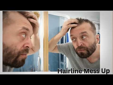 Messed Up Hairline: How To Fix A Messed Up Hairline