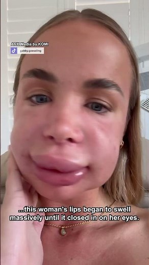When filler dissolving goes wrong 💋