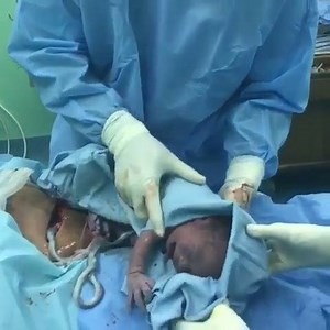 67K views · 1K reactions | A full intact birth is rare in a...