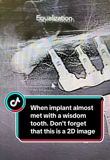 Implant Interaction with Wisdom Tooth Explained
