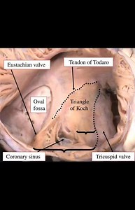 Koch's triangle | Cardiology and CCU
