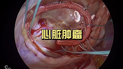 心脏肿瘤——右心室黏液瘤切除术（非医学相关专业慎入）