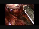 Hand Assisted Laparoscopic Splenectomy: How to Avoid Conversion in a Difficult Case • Video • MEDtube.net