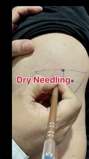 Dry Needling Deltoid Muscle Injury #physiotherapist #dryneedling #muscleinjury