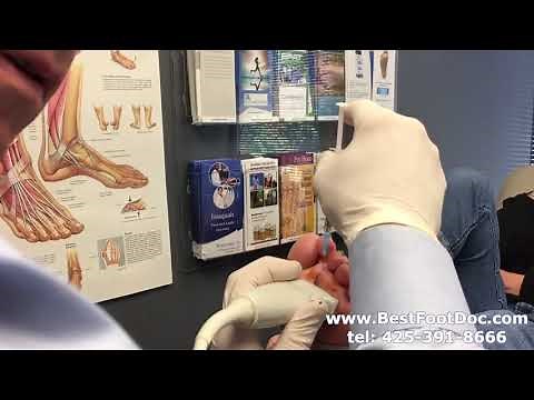 Dehydrated Alcohol Injection For Neuroma -- Live