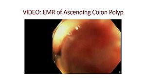 Endoscopic Resection of Colon Polyps - 2023