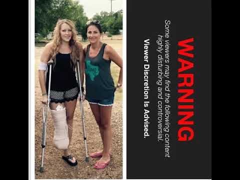 Amputation Photos Warning Below Knee amputation from MRSA