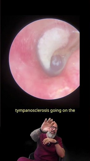 A Grommet Hidden in Ear Wax Since Childhood 😱👂