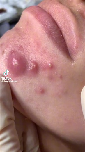 Videos de granos y espinillas (@granos.espinillas2023) con “sonido original - granos y espinillas”