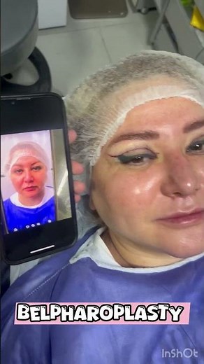 Upper Eyelid Blepharoplasty Before & After | Stunning Eye Transformation Results