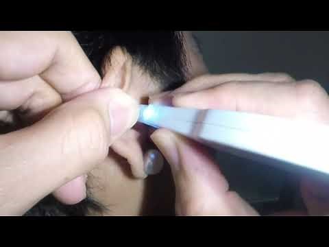 Elderly Woman's Dry Crusty Earwax Removal