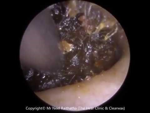 Blocked Ear Removal Extraction by Ear Wax Removal Specialist Mr Raithatha Ep 287
