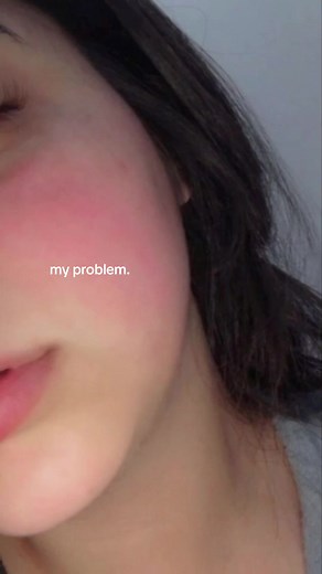 Understanding Red Cheeks: Causes and Remedies