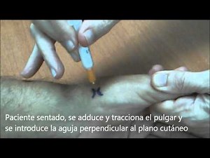 Infiltracion rizartrosis AP