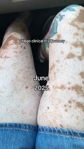 Vitiligo Clinical Trial Journey: My Experience with Pfizer