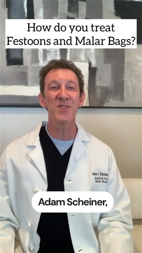 ⚕️Dr. Adam Scheiner on Instagram: "Do festoons or malar bags make the under-eye area look puffy or swollen, even when well rested? These issues go beyond surface appearance. Festoons, also called malar bags, are caused by fluid buildup and weakened tissue in the upper cheek area. Unlike typical under-eye bags, they are more persistent and more difficult to treat. Creams and fillers often worsen the condition rather than improve it. This video features Dr. Adam Scheiner, a facial cosmetic surgeon