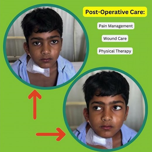 Bipolar release of SCM Muscle #SCMSurgery #BipolarRelease #surgicalprocedure #medicaleducation