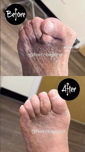 SEVERE CROSSOVER TOES