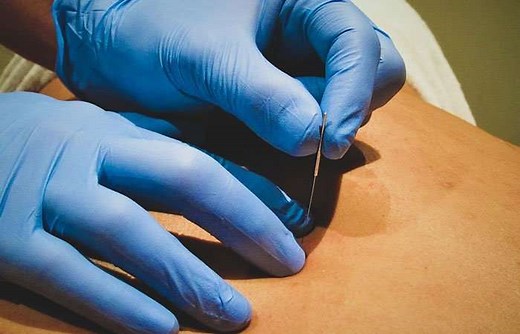 Dry Needling Level One - Foundations of Dry Needling - GEMt