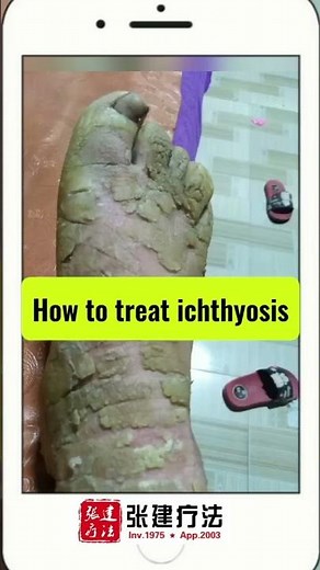 How to treat ichthyosis? #ichthyosistreatment #ichthyosis#ichthyosisvulgaris​