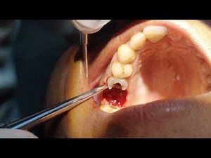 Crown Broke During Extraction. How to Extract Rest of The Root Pieces