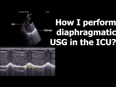 How I perform diaphragmatic USG in the ICU?