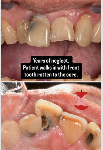 How do you fix this tooth when it is rotten to the core? 😳 #cavity #dentist #dentalhygienist #dentalstudent #dentistry #dentaloffice #dentalassistant #toothdecay #decay #caries #endodontics