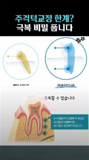 주걱턱교정? 한계 없다니까요~