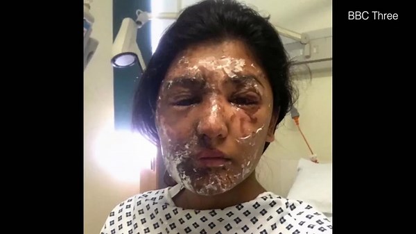 Acid attack survivor terrified at workers handling sulphuric acid