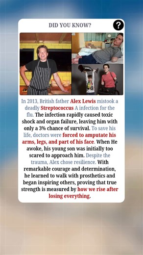 In 2013, British father Alex Lewis faced a nightmare few could imagine. What began as what he thought was the flu turned out to be a deadly Streptococcus A infection. Within days, the infection triggered toxic shock and multiple organ failure, leaving him with just a 3% chance of survival. To save his life, doctors had to amputate his arms, legs, and part of his face. When Alex finally awoke, his young son was frightened by his new appearance — but over time, love and courage rebuilt what illnes