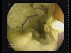 #sigmoid_volvulus #volvulus_deflation COLONOSCOPIC SIGMOID VOLVULUS DEFLATION ,DR MASFIQUE A BHUIYAN