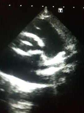 Patent Ductus Arteriosus | Echocardiography