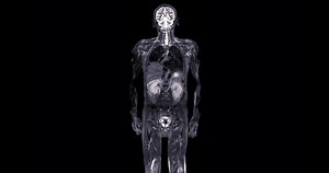 Mri Whole Body Scan Human Coronal Stock Footage Video (100% Royalty-free) 1097489307 | Shutterstock