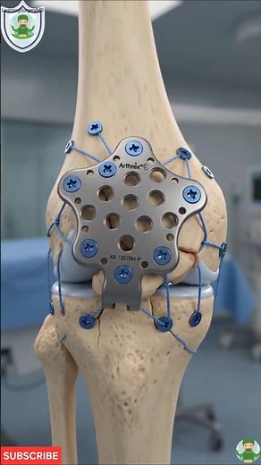 How Do Surgeons Fix a Shattered Kneecap? | Patella Fracture Repair Explained