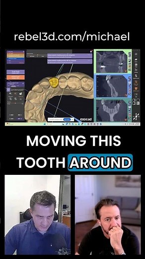 Nobel conical connection. ExoPlan workflow. Familiar tools, smoother planning.