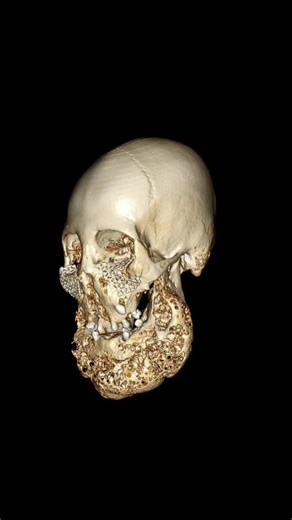 Cherubism: Understanding a Rare Genetic Disorder