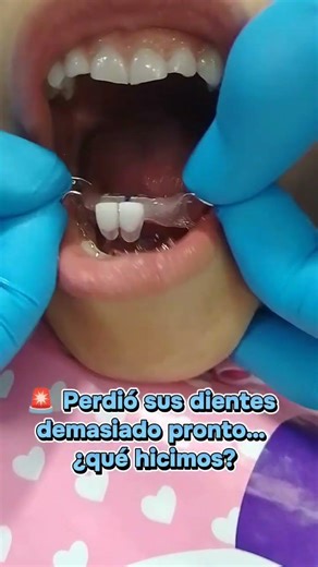 🦷 Perdió sus dientes de leche demasiado pronto… así recuperamos su sonrisa
