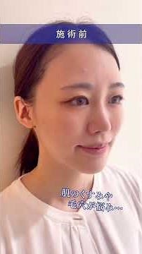 【美容レポ】ナビジョンのケミカルピーリング「NAVIピール」を体験！ #美容 #スキンケア#美容医療 #ピーリング